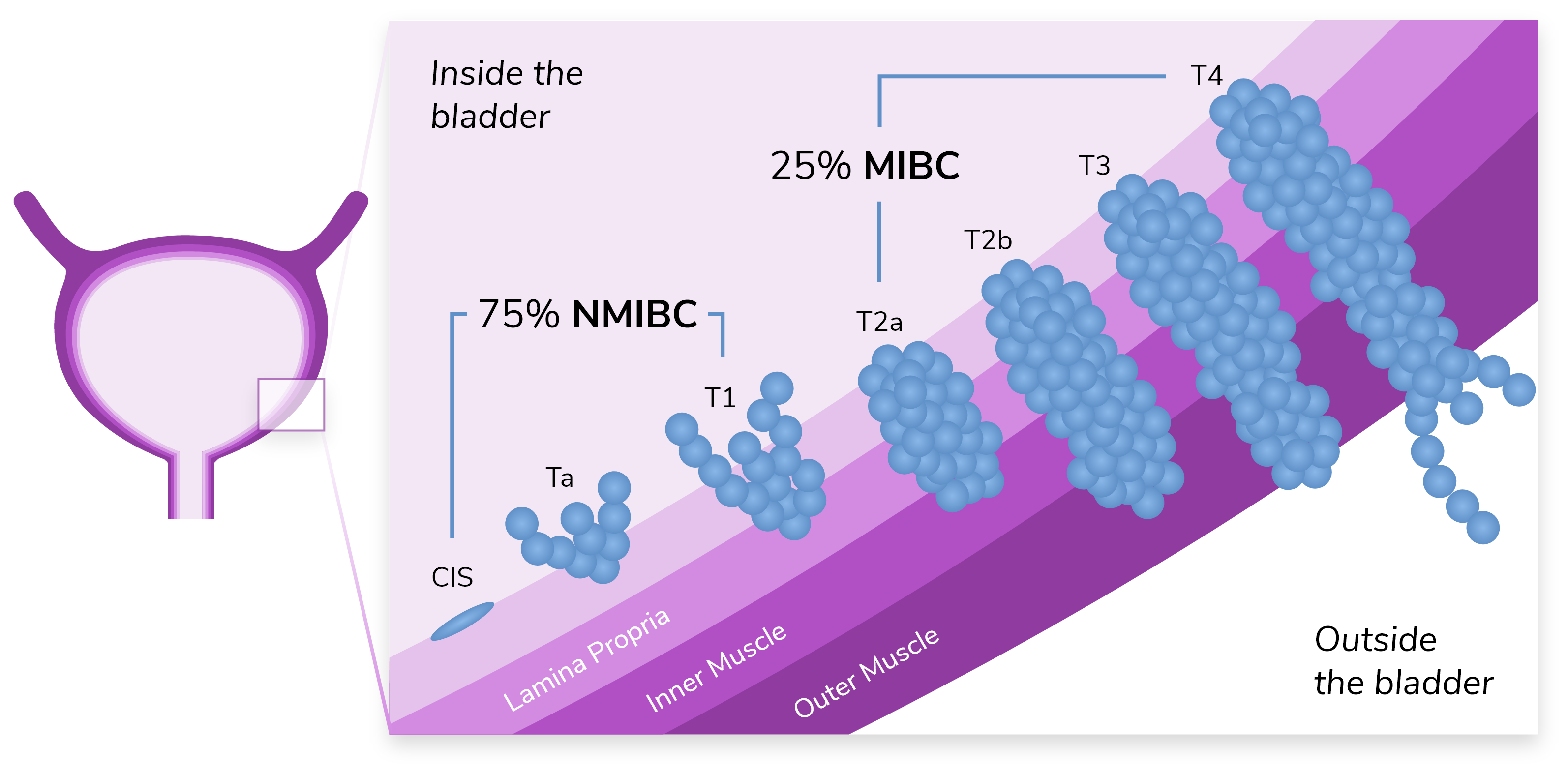 Inset image of a bladder, illustrating the stage at which bladder cancer patients are usually diagnosed